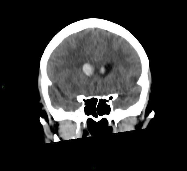 File:Cerebral amyloid angiopathy-associated lobar intracerebral hemorrhage (Radiopaedia 58566-65730 Coronal non-contrast 47).jpg