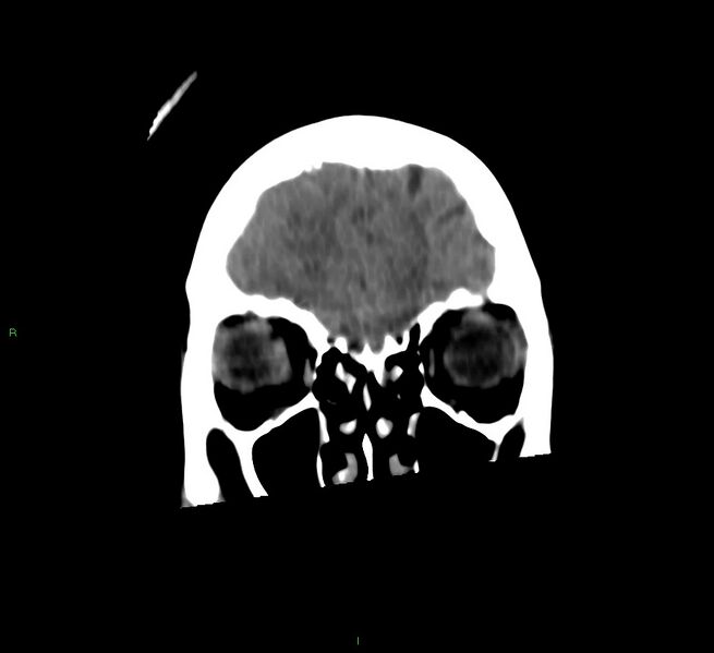 File:Cerebral amyloid angiopathy-associated lobar intracerebral hemorrhage (Radiopaedia 58566-65730 Coronal non-contrast 57).jpg