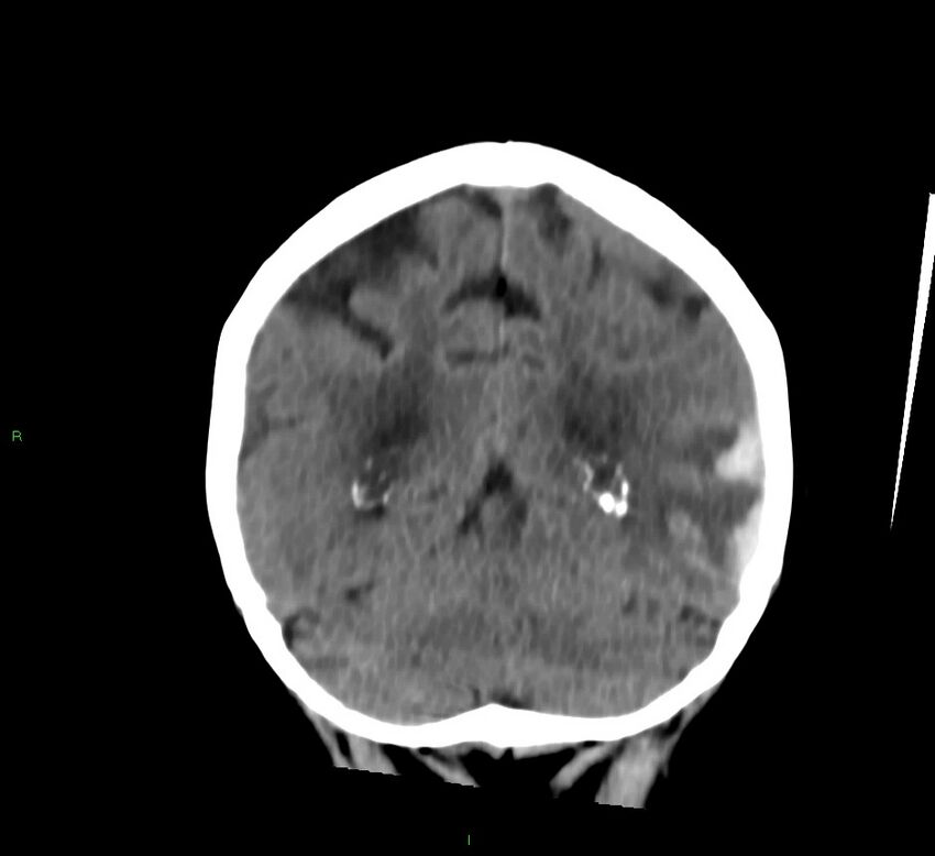 Cerebral amyloid angiopathy-associated lobar intracerebral hemorrhage (Radiopaedia 58757-65978 Coronal non-contrast 22).jpg