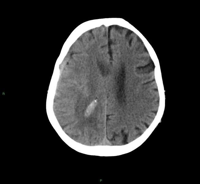 File:Cerebral amyloid angiopathy-associated lobar intracerebral hemorrhage (Radiopaedia 58758-65980 Axial non-contrast 18).jpg