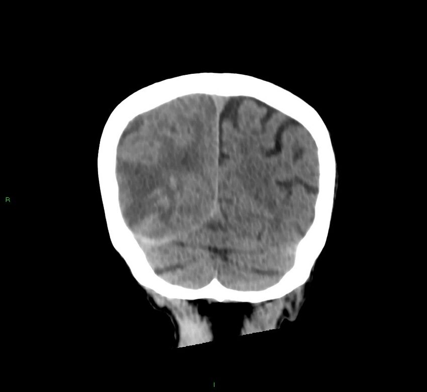 Cerebral amyloid angiopathy-associated lobar intracerebral hemorrhage (Radiopaedia 58758-65980 Coronal non-contrast 16).jpg