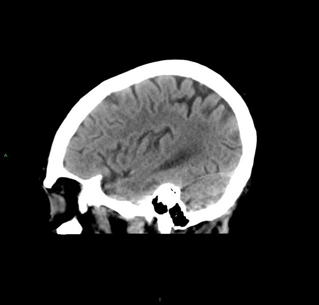 File:Cerebral amyloid angiopathy-associated lobar intracerebral hemorrhage (Radiopaedia 59356-66716 C 41).jpg