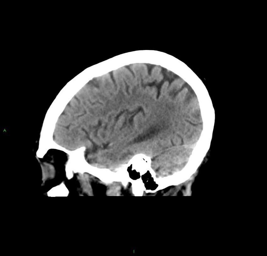 Cerebral amyloid angiopathy-associated lobar intracerebral hemorrhage (Radiopaedia 59356-66716 C 41).jpg