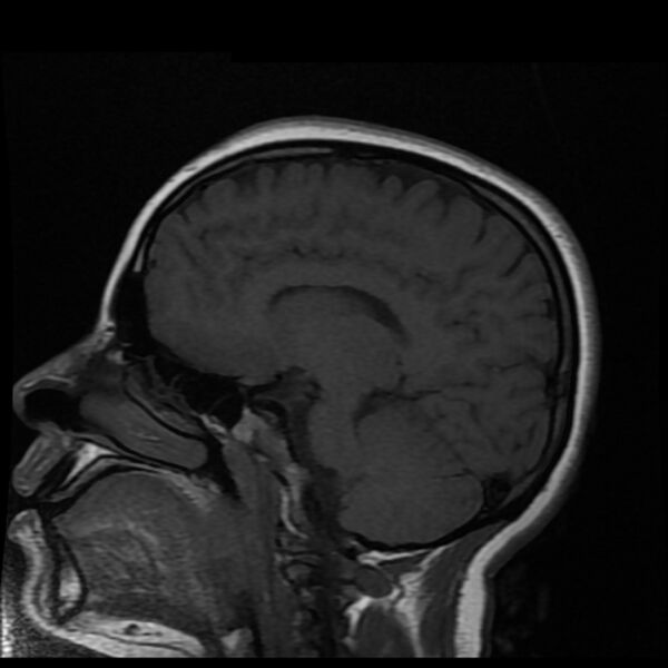 File:Cerebral cavernous malformation (Radiopaedia 44301-47942 Sagittal T1 12).jpg
