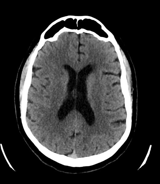 File:Cerebral dural venous sinus thrombosis (Radiopaedia 86514-102575 Axial non-contrast 26).jpg