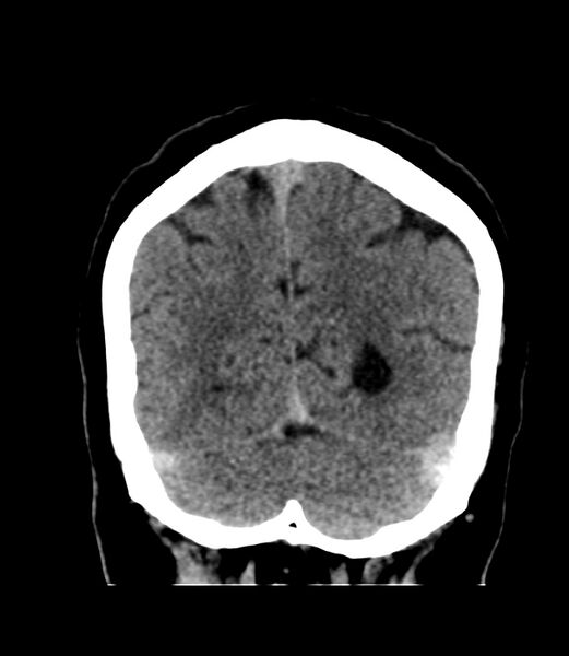 File:Cerebral dural venous sinus thrombosis (Radiopaedia 86514-102575 Coronal non-contrast 43).jpg
