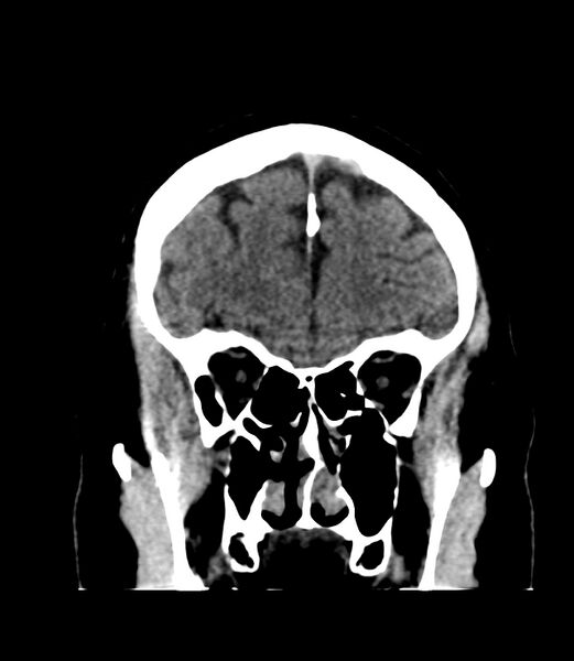 File:Cerebral dural venous sinus thrombosis (Radiopaedia 86514-102575 Coronal non-contrast 8).jpg