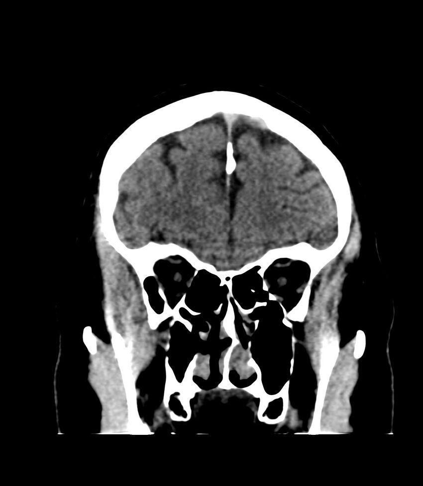 Cerebral dural venous sinus thrombosis (Radiopaedia 86514-102575 Coronal non-contrast 8).jpg
