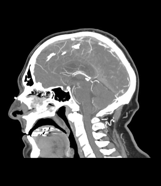File:Cerebral dural venous sinus thrombosis (Radiopaedia 86514-102576 C 28).jpg