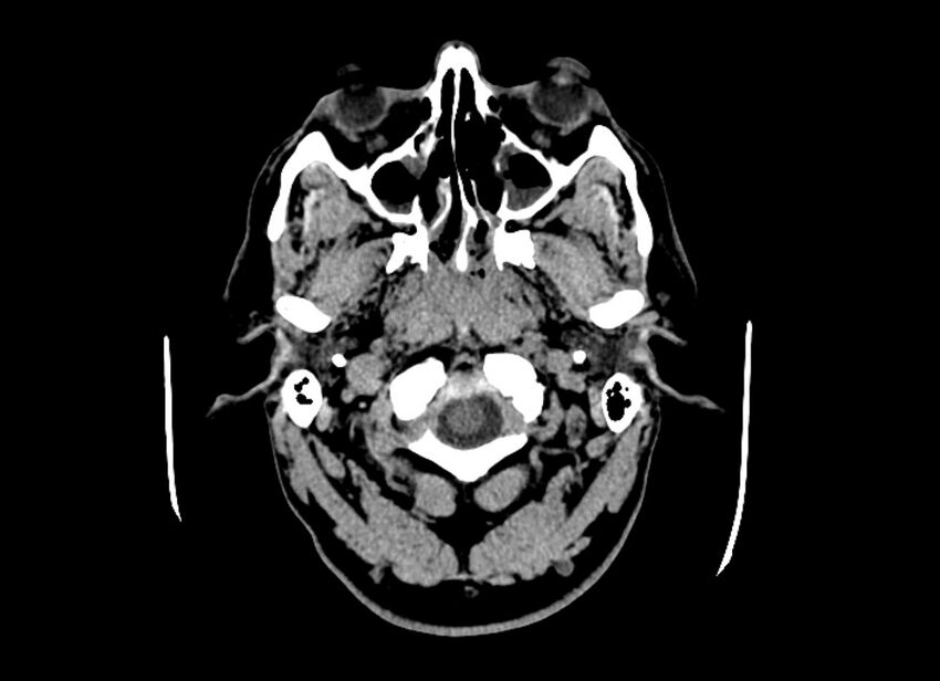Cerebral edema (Radiopaedia 82519-96661 Axial non-contrast 52).jpg