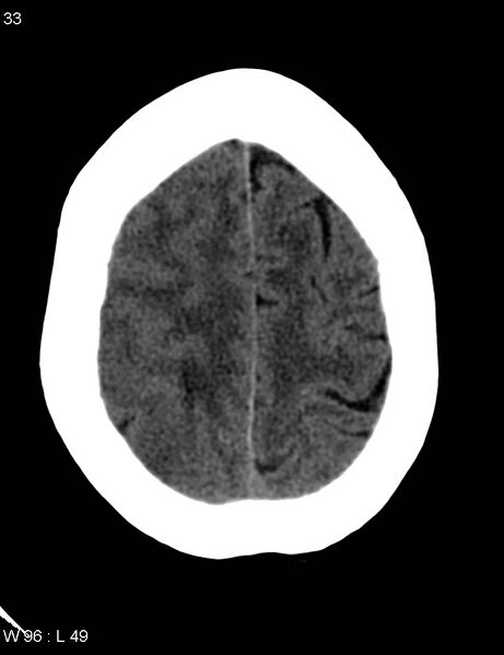 File:Cerebral metastasis - lung cancer (Radiopaedia 5315-7072 Axial non-contrast 12).jpg