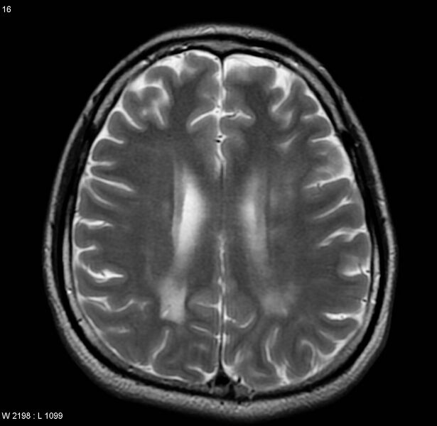 File:Cerebral vasculitis (Radiopaedia 5131-6923 Axial T2 7).jpg