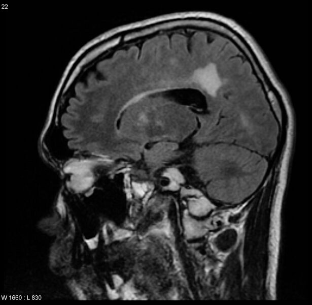 File:Cerebral vasculitis (Radiopaedia 5131-6923 Sagittal FLAIR 7).jpg