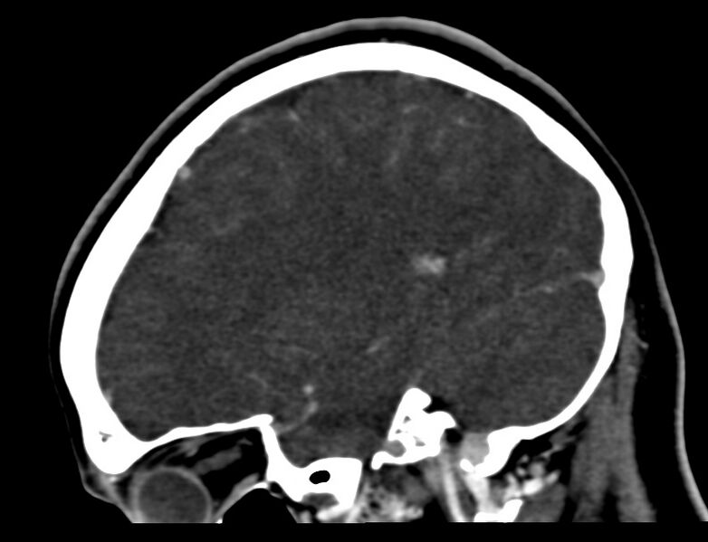 File:Cerebral venous sinus thrombosis (Radiopaedia 59224-66646 Sagittal C+ delayed 7).jpg