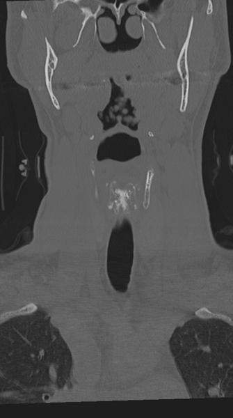 File:Cervical intercalary bone (Radiopaedia 35211-36748 Coronal bone window 16).png