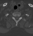 Cervical spine ACDF loosening (Radiopaedia 48998-54070 Axial bone window 52).png