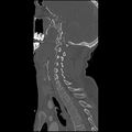 Cervical spine fractures with vertebral artery dissection (Radiopaedia 32135-33078 Sagittal bone window 14).jpg