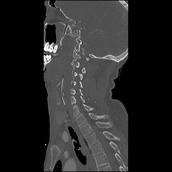 File:Cervical spine fractures with vertebral artery dissection (Radiopaedia 32135-33078 Sagittal bone window 14).jpg