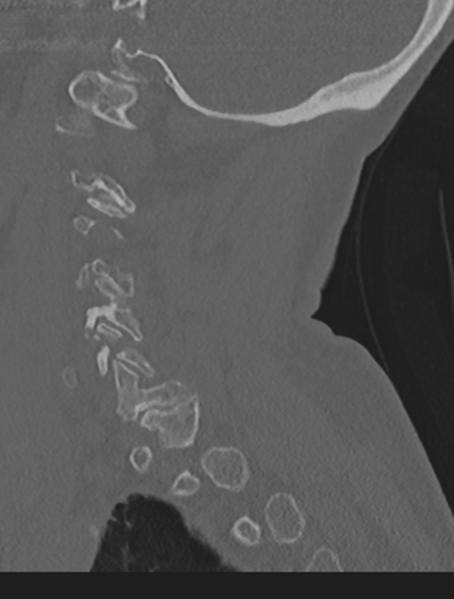 File:Cervical spondylolysis (Radiopaedia 49616-54811 Sagittal bone window 53).png