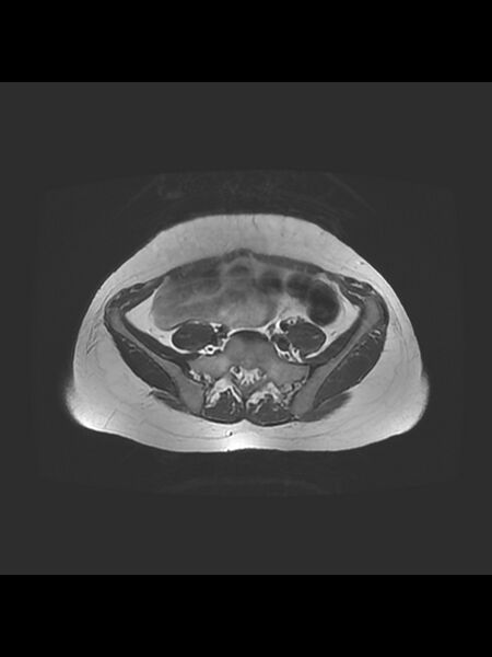 File:Cesarean section scar endometrioma (Radiopaedia 56569-63297 Axial T2 2).jpg