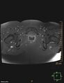 Cesarian scar endometriosis (Radiopaedia 68495-78066 Axial T1 C+ fat sat 23).jpg