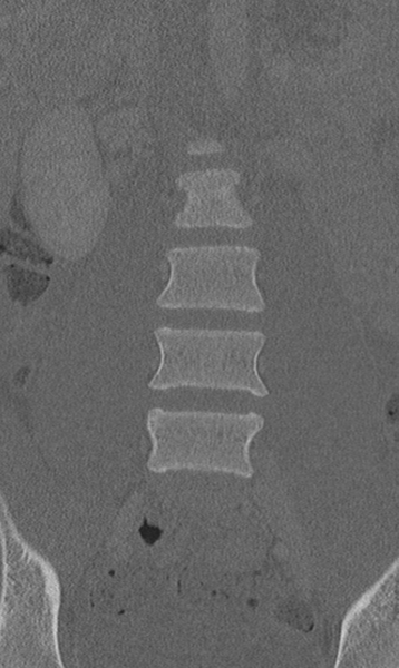 File:Chance fracture (Radiopaedia 40360-42912 Coronal bone window 20).png