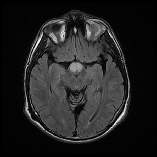 File:Chiasmatic-hypothalamic juvenile pilocytic astrocytoma (Radiopaedia 78533-91235 Axial FLAIR 13).jpg