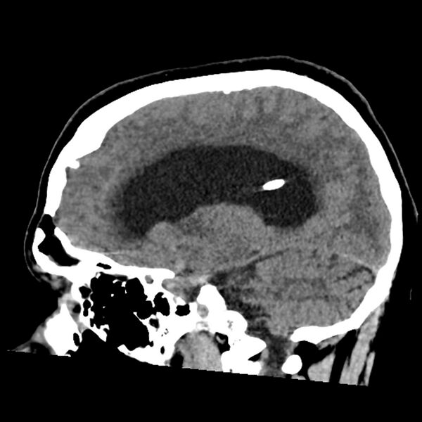 File:Chiasmatic-hypothalamic juvenile pilocytic astrocytoma (Radiopaedia 78533-91237 B 38).jpg
