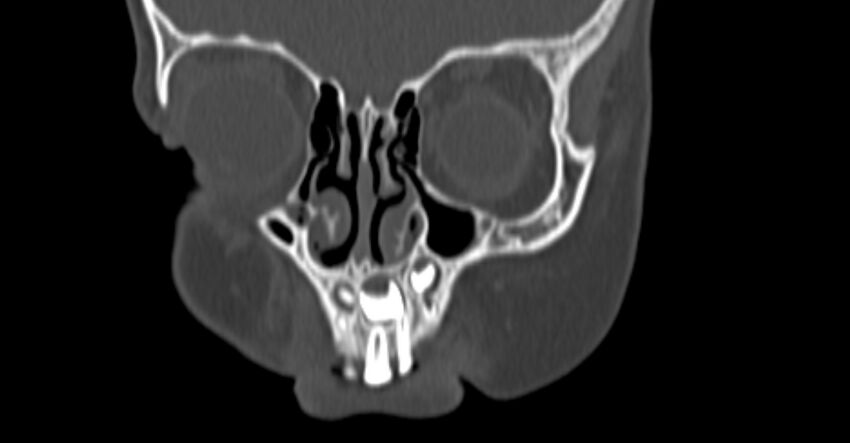 Choanal atresia (Radiopaedia 51295-56972 Coronal bone window 8).jpg