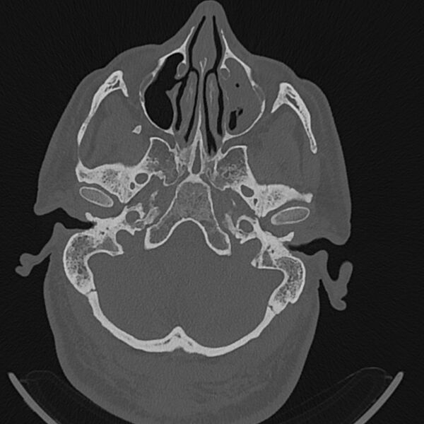 File:Cholesteatoma (Radiopaedia 68176-77673 Axial bone window 16).jpg