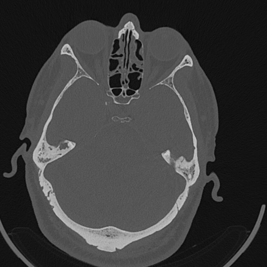 Cholesteatoma (Radiopaedia 68176-77673 Axial bone window 70).jpg