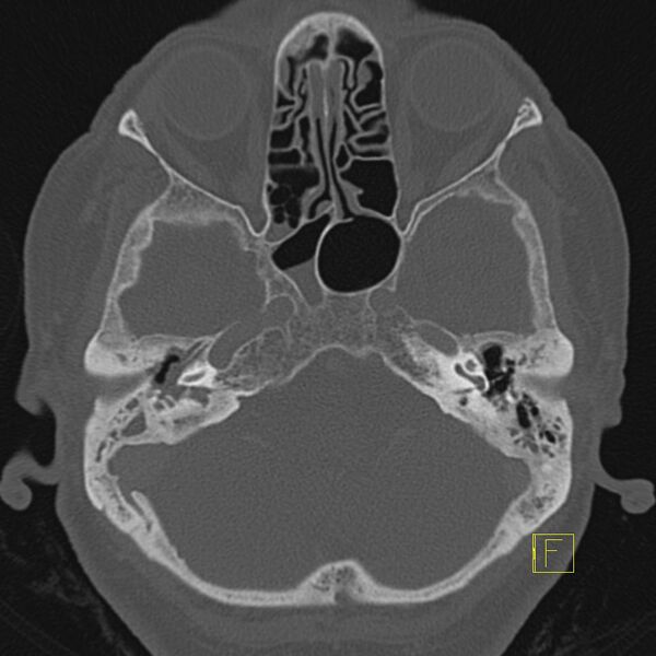 File:Cholesteatomatous chronic otitis (Radiopaedia 14993-14911 Axial bone window 1).JPEG