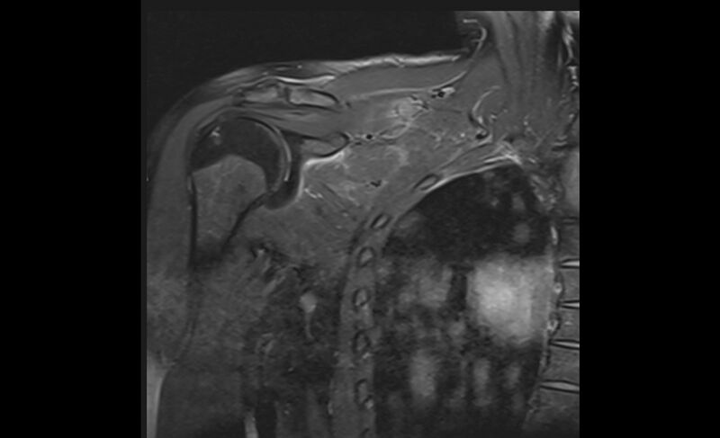File:Choriocarcinoma in the shoulder (Radiopaedia 28603-28861 Coronal PD FS 9).jpg