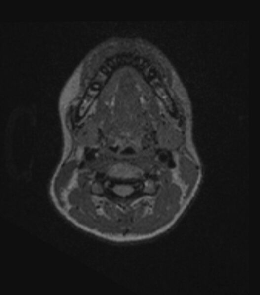 File:Choroid plexus carcinoma (Radiopaedia 91013-108553 Axial FLAIR C+ 25).jpg