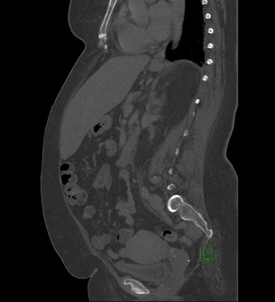 File:Chromophobe renal cell carcinoma (Radiopaedia 84239-99519 Sagittal bone window 48).jpg