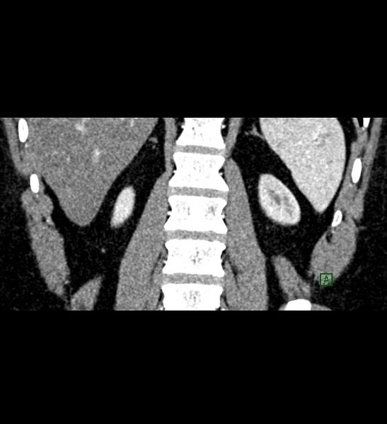 File:Chromophobe renal cell carcinoma (Radiopaedia 84286-99573 E 71).jpg