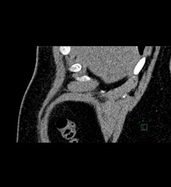 File:Chromophobe renal cell carcinoma (Radiopaedia 84286-99573 F 166).jpg