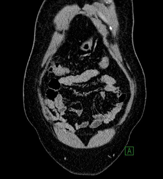 File:Chromophobe renal cell carcinoma (Radiopaedia 84286-99573 H 28).jpg