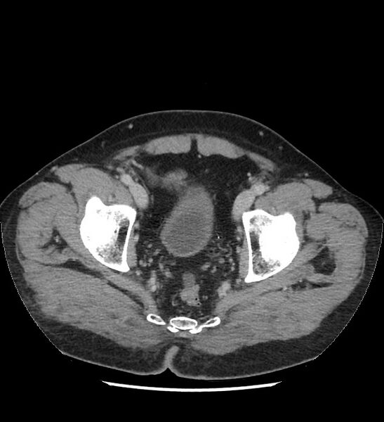 File:Chromophobe renal cell carcinoma (Radiopaedia 86879-103083 C 138).jpg