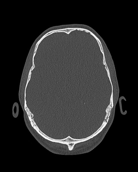 File:Chronic maxillary sinusitis caused by a foreign body (Radiopaedia 58521-65676 Axial bone window 324).jpg
