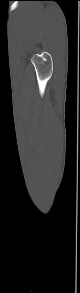 File:Chronic osteomyelitis (with sequestrum) (Radiopaedia 74813-85822 C 16).jpg