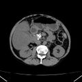 Chronic pancreatitis (Radiopaedia 23132-23172 Axial non-contrast 34).jpg