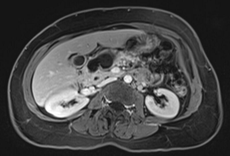 File:Chronic pancreatitis - pancreatic duct calculi (Radiopaedia 71818-82250 Axial T1 C+ fat sat 35).jpg