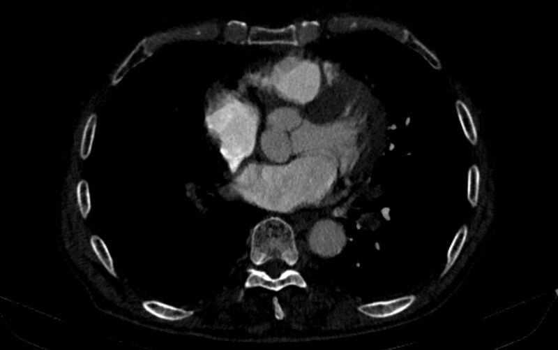 File:Chronic pulmonary embolism (Radiopaedia 91241-108843 B 118).jpg