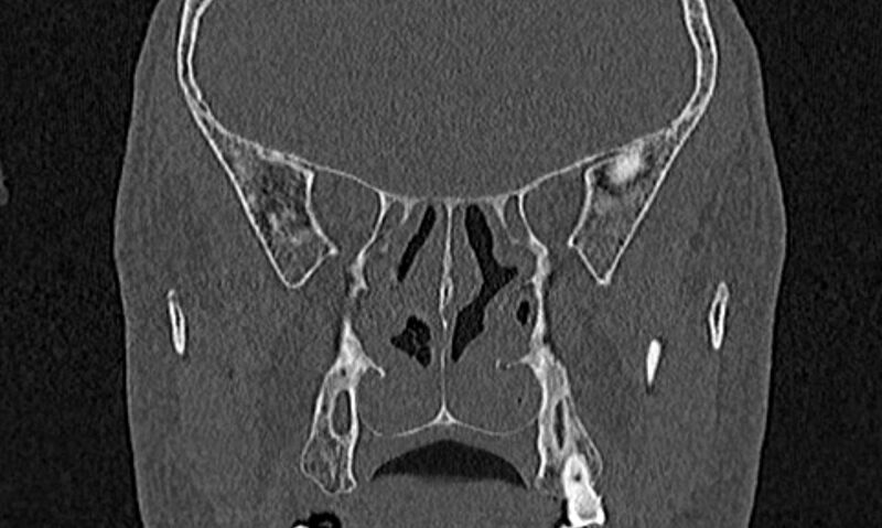 File:Chronic rhinosinusitis (Radiopaedia 65079-74075 Coronal bone window 55).jpg