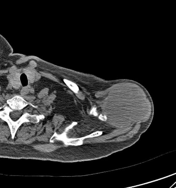 File:Clear cell chondrosarcoma - humerus (Radiopaedia 63104-71612 Axial non-contrast 20).jpg