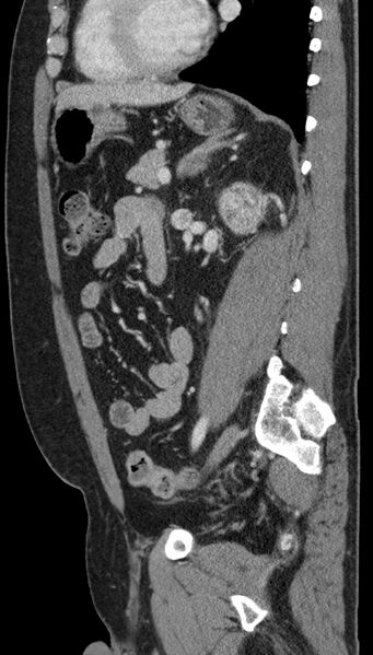 File:Clear cell renal cell carcinoma (Radiopaedia 61449-69393 G 39).jpg