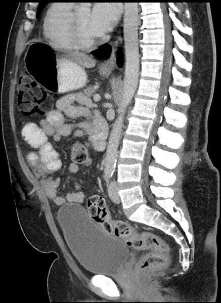 File:Closed loop obstruction - internal hernia into nephrectomy bed (Radiopaedia 59867-67320 C 44).jpg