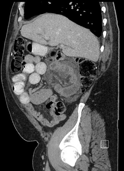 File:Closed loop obstruction - internal hernia into nephrectomy bed (Radiopaedia 59867-67320 C 75).jpg