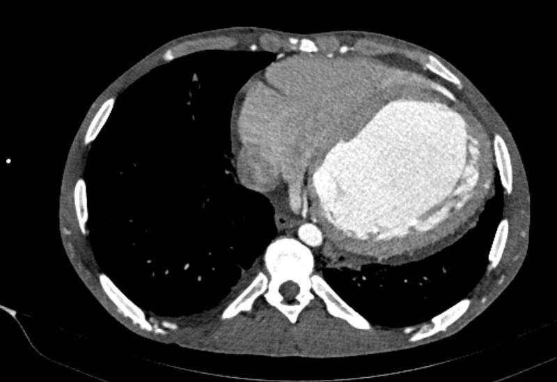 File:Coarctation of aorta with aortic valve stenosis (Radiopaedia 70463-80574 A 163).jpg
